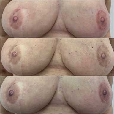 stages of areola tattooing